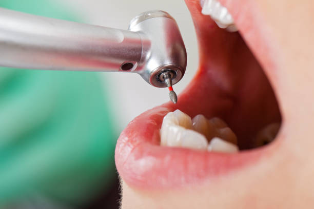 Best Emergency Root Canal Therapy in Borger, TX